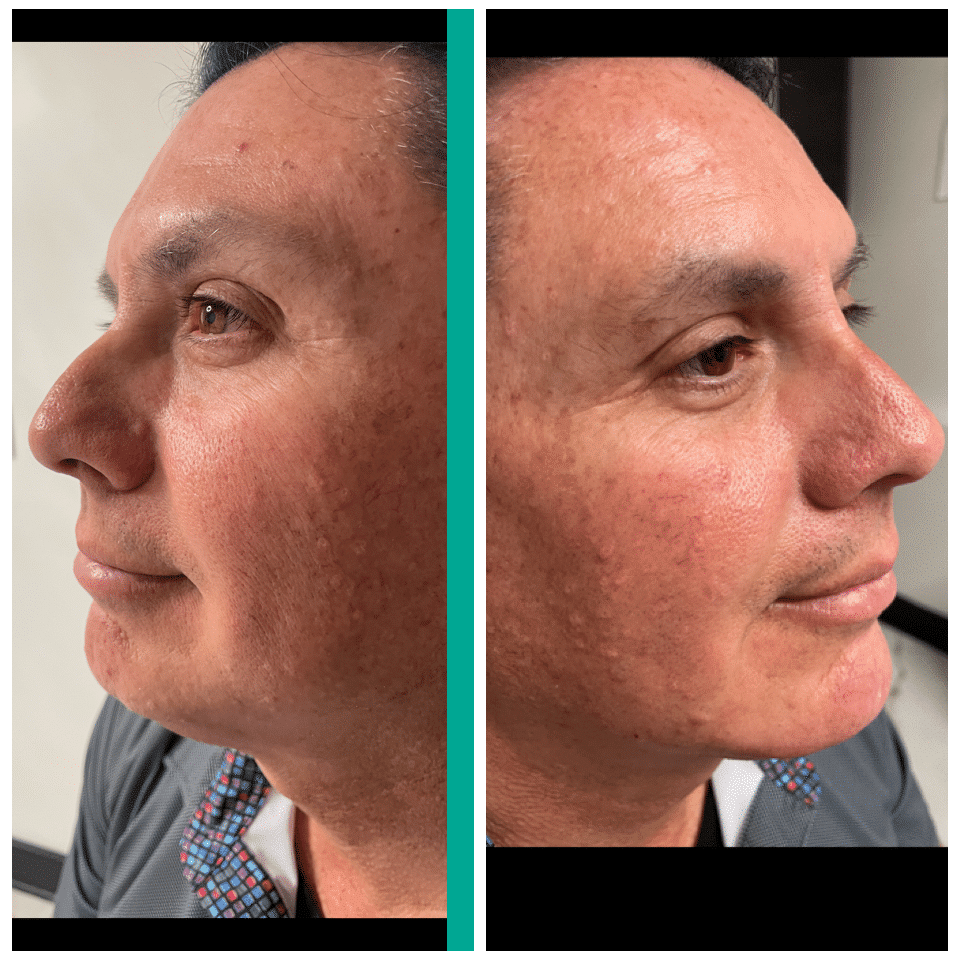 Before and After Image: Nasal Correction - front