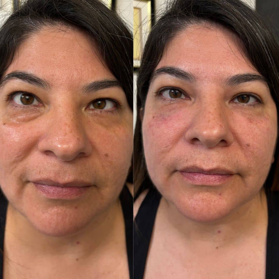 Before and After Image: Under Eyes - front