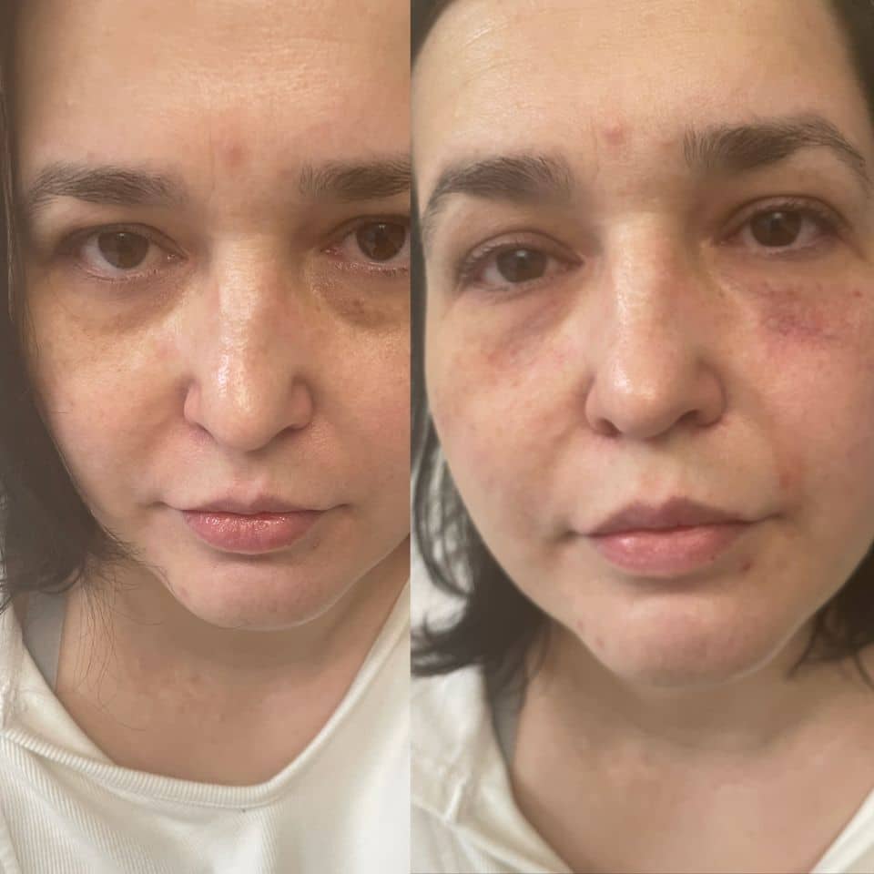 Before and After Image: Under Eyes - front