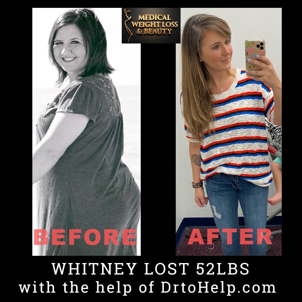 Before and After Image: Weight Loss - front
