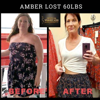Before and After Image: Weight Loss - front